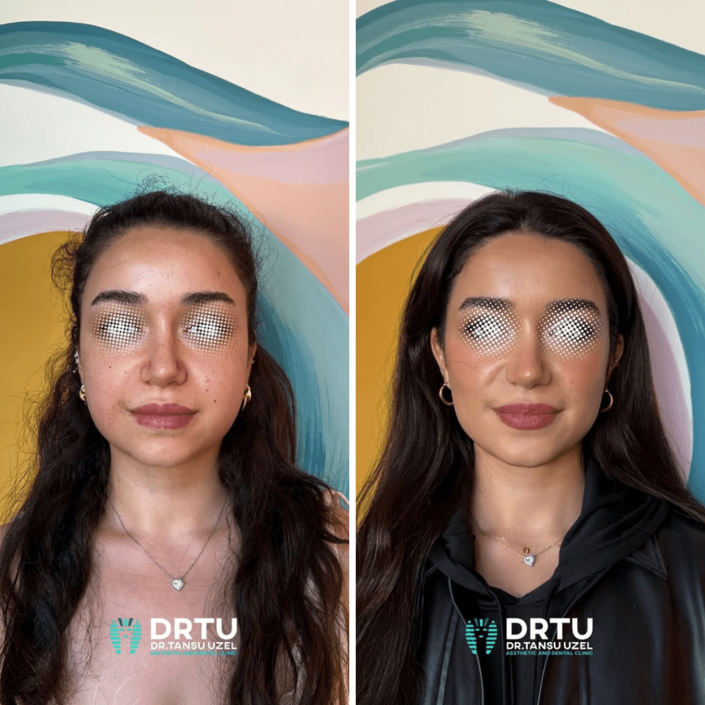 bisektomi oncesi ve sonrasi min