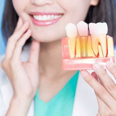 implant mı kopru mu