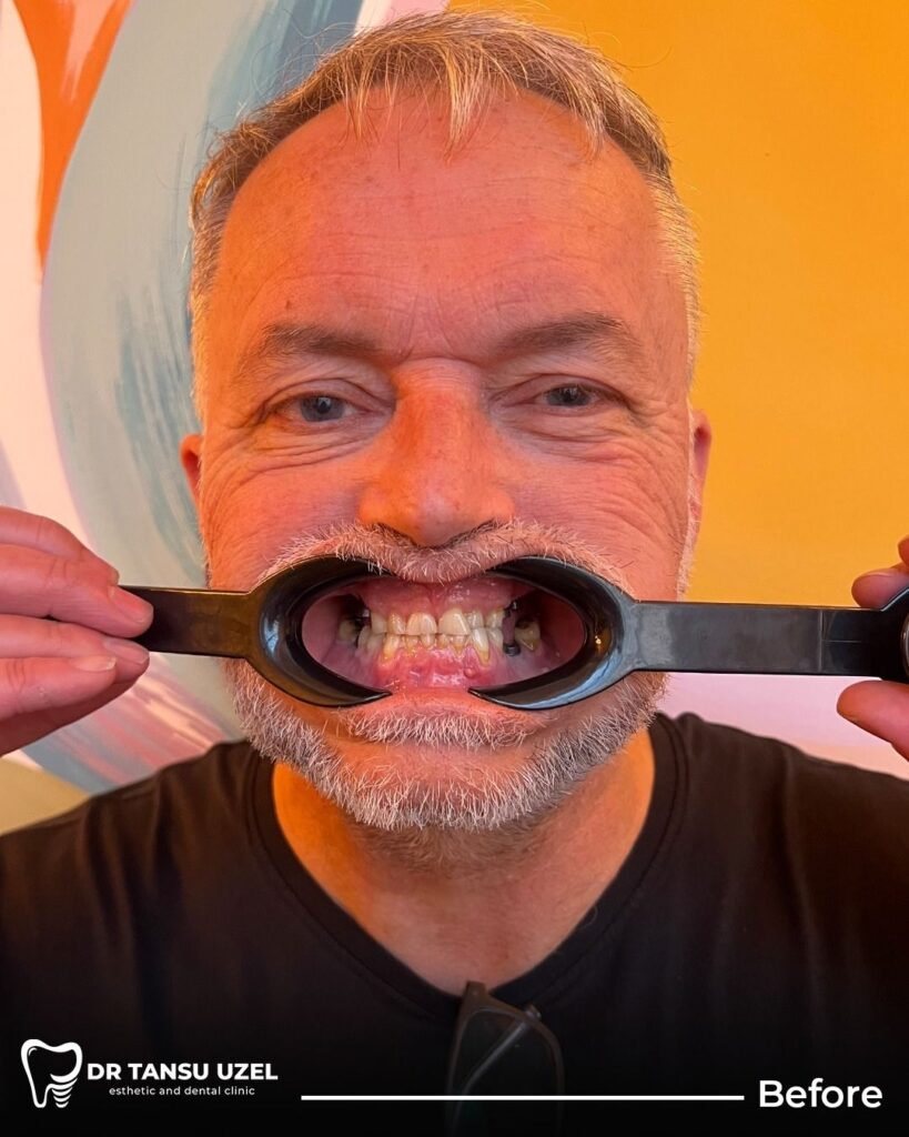 implant sırasında