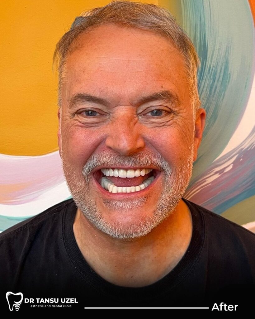 implant sonrası