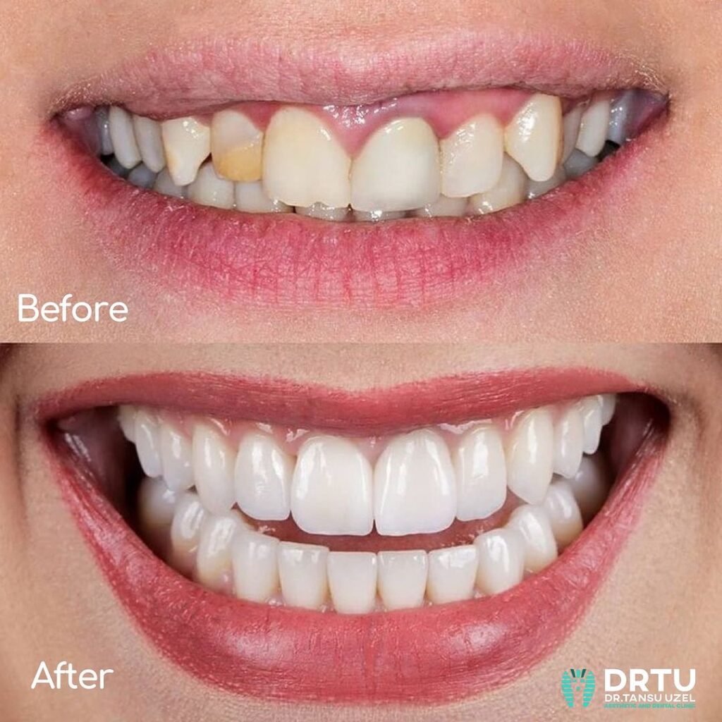 gülüş tasarımı yaptıranlar öncesi ve sonrası