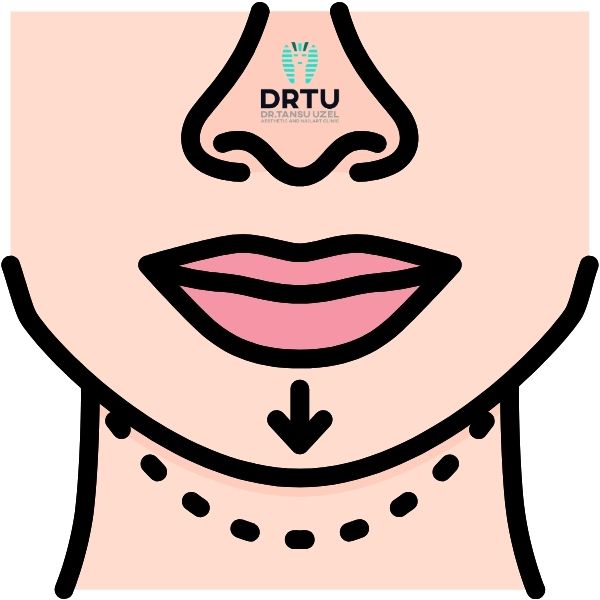 what is genioplasty chin surgery and its processes