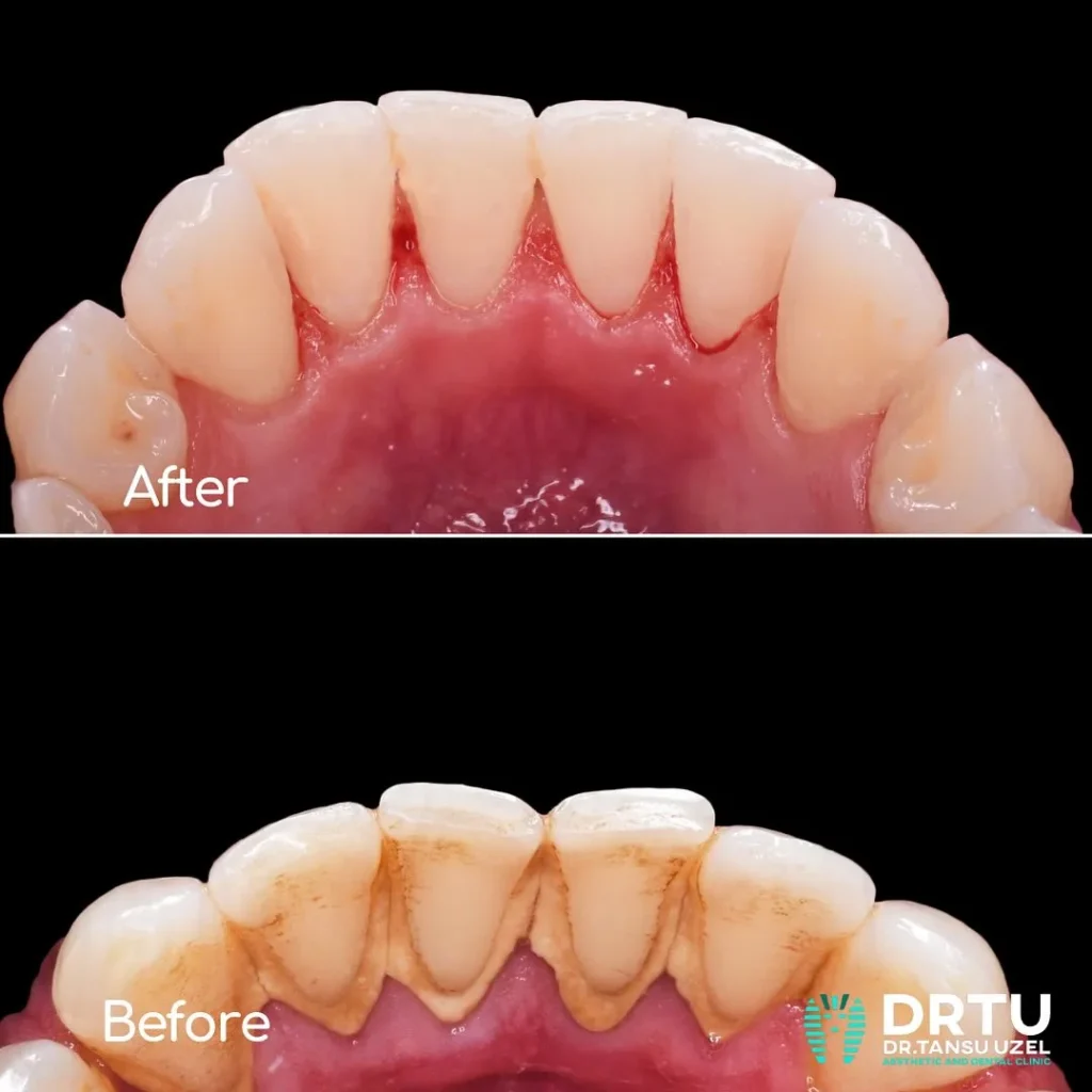 drtu periodontoji