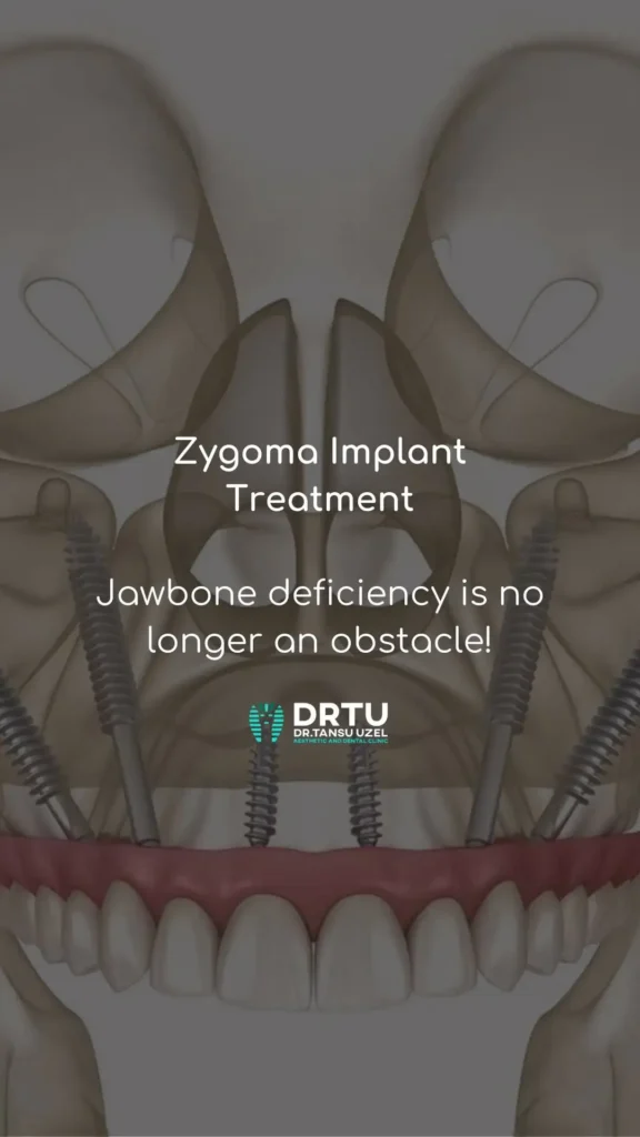drtu zigoma implant