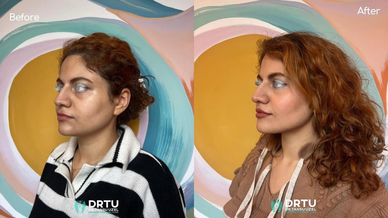 Bişektomi Fiyatları 2026