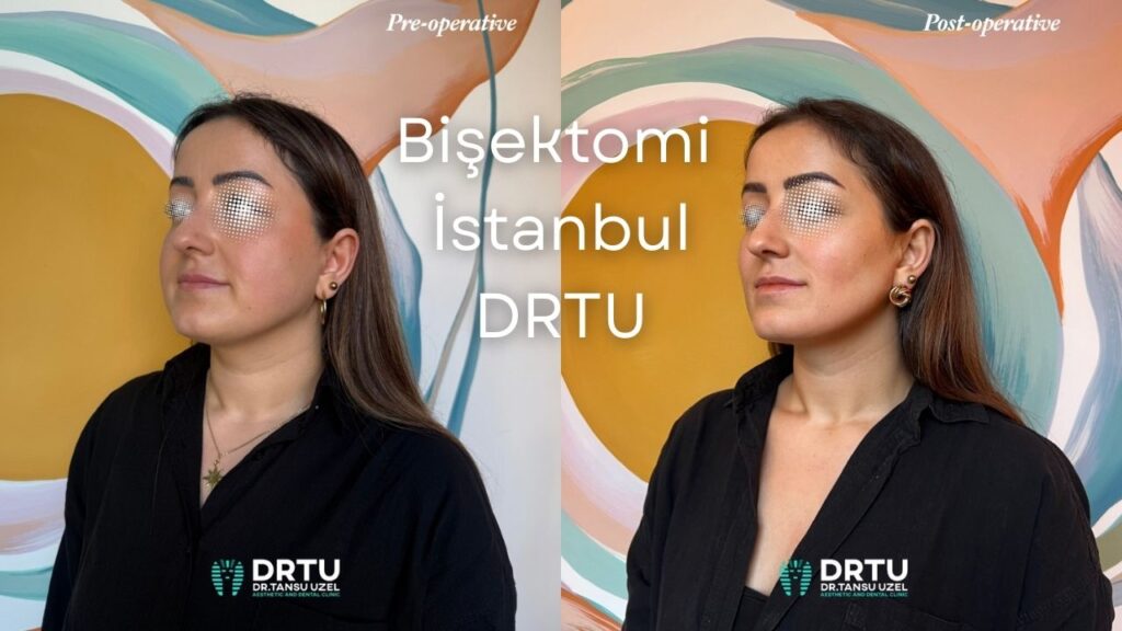 Bişektomi İstanbul