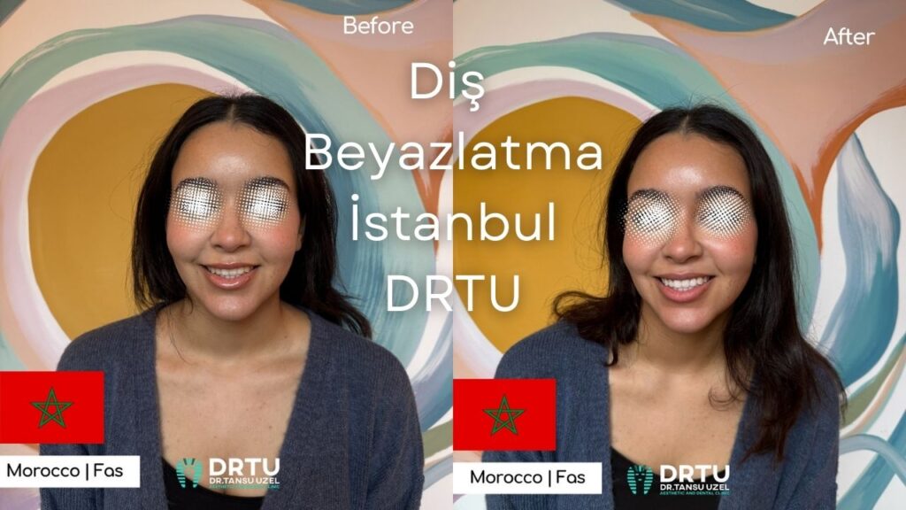 Diş Beyazlatma Beoğlu İstanbul