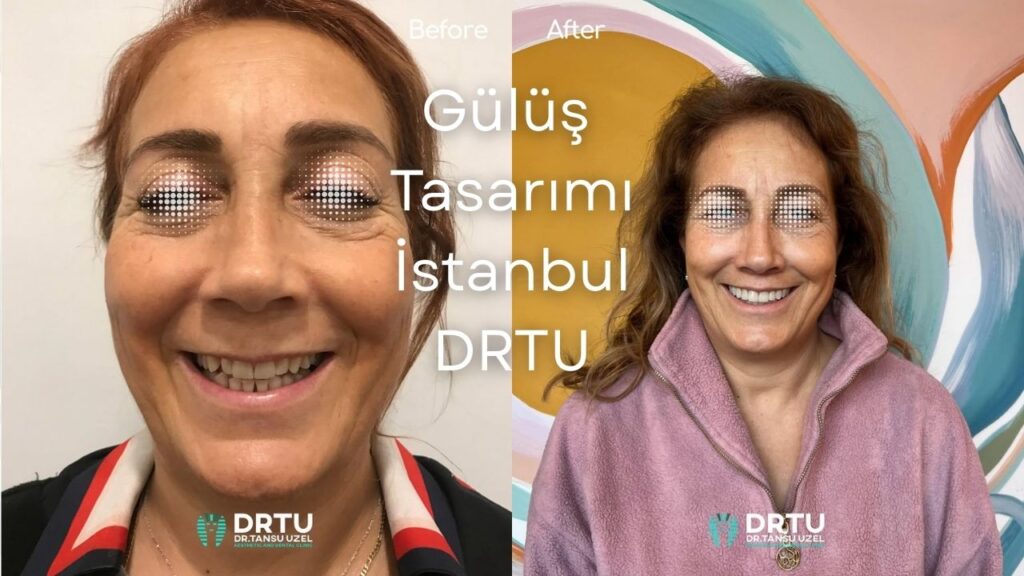 Gülüş Tasarımı İstanbul