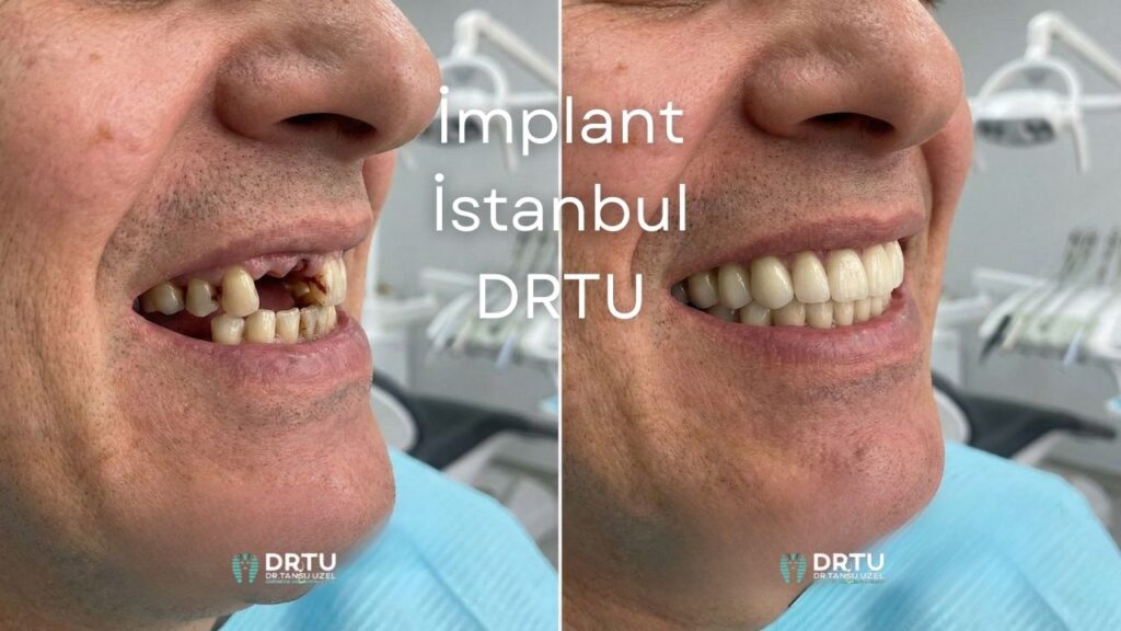 Implant Istanbul