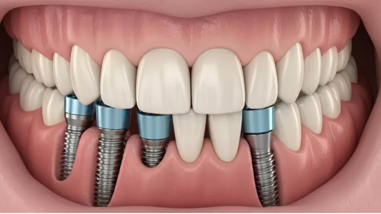 beyoglu ve galatada on bolge implant tedaviler