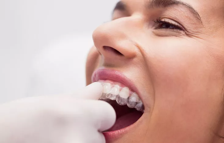 Invisalign seffaf plak tedavisi