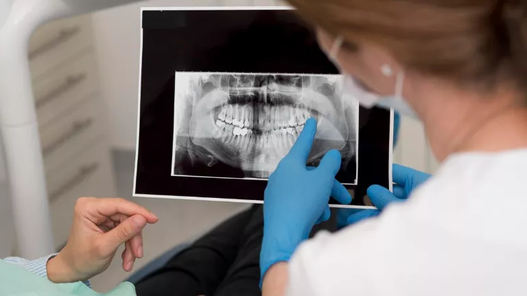 quad zygoma dort zigomatik implant tedavisi nedir